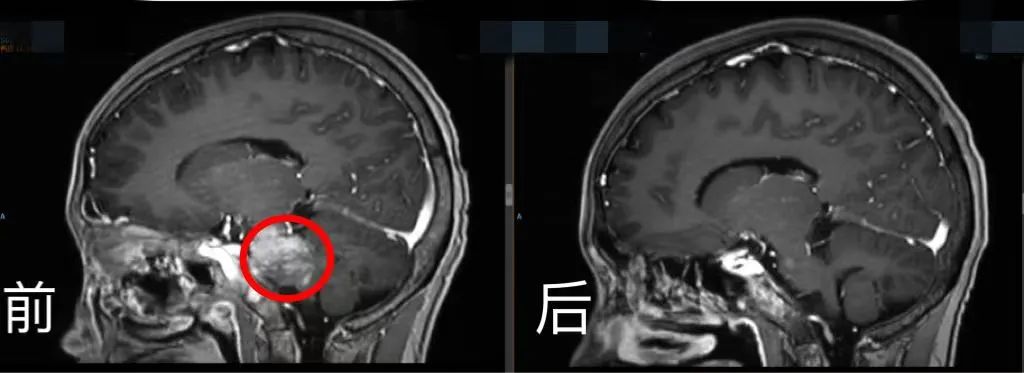 腦部CT前后對(duì)比。四川省腫瘤醫(yī)院供圖