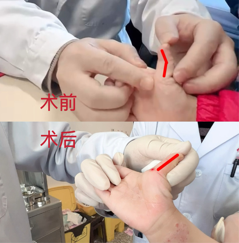 治療前后患者情況對比。四川省骨科醫院供圖